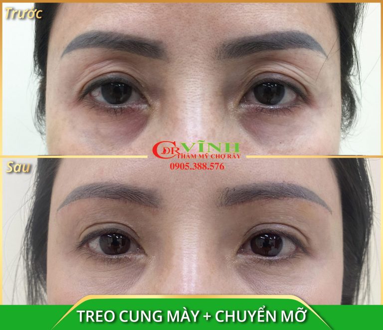 TREO-CUNG-MAY-CHUYEN-MO-scaled.jpg