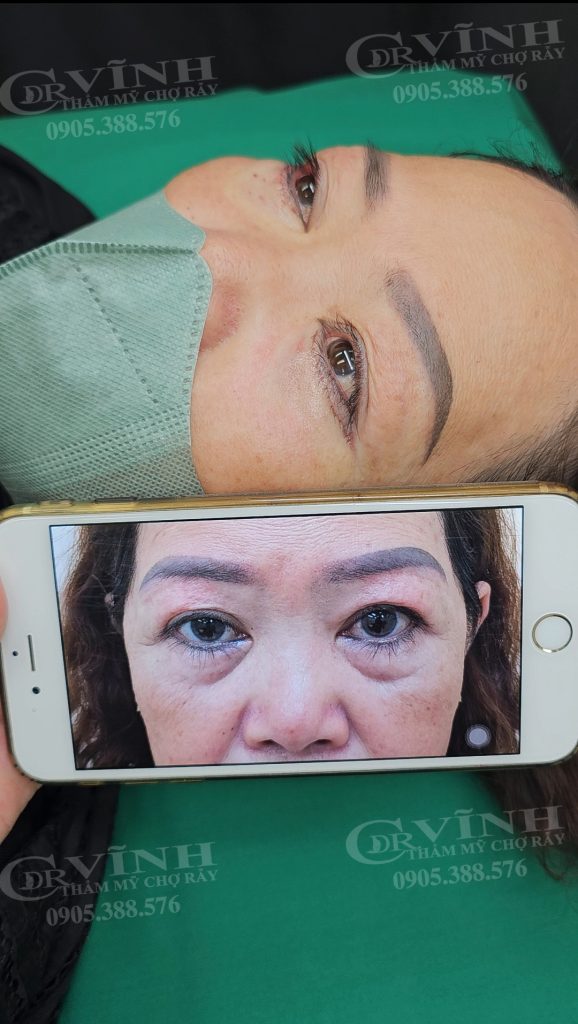 ket-qua-phau-thuat-tham-my-lay-mo-bong-mat