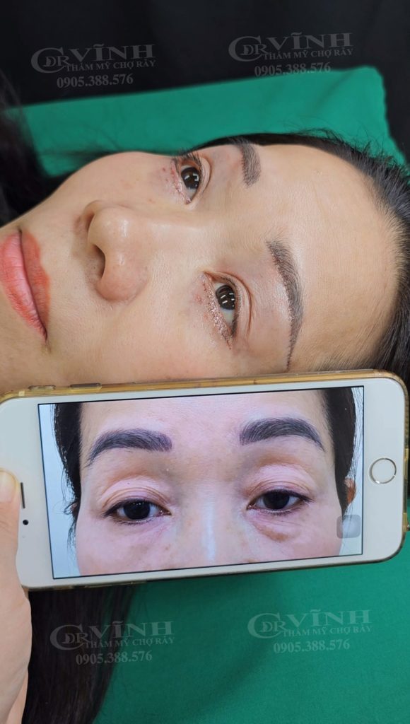 khach-hang-sau-khi-phau-thuat-tham-my-lay-mo-bong-mat