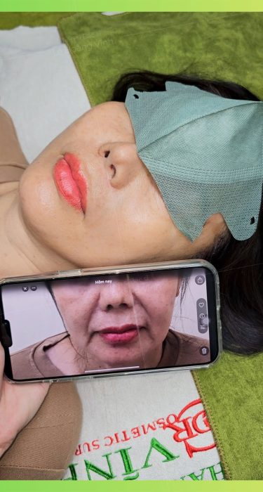 cang-da-mat-tre-hoa-tai-phong-kham-phau-thuat-tham-my