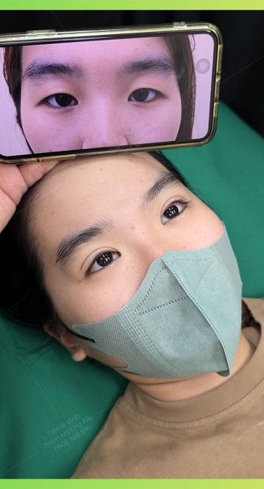 cat-mi-mini-line-truoc-va-sau-khi-thuc-hien