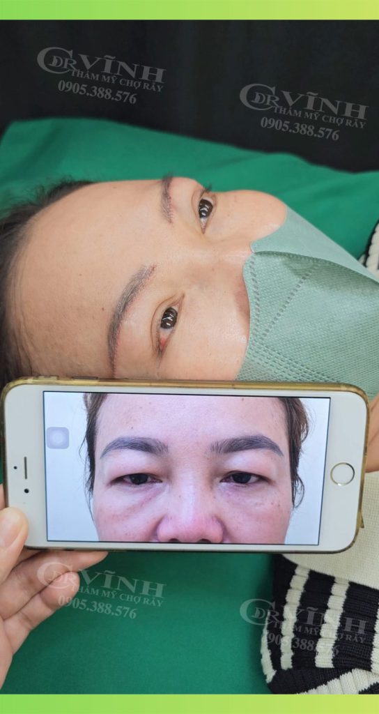 hinh-anh-truoc-sau-lay-mo-mi-mat-tren-phong-kham-phau-thuat-tham-my