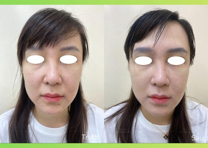 hinh-anh-truoc-va-sau-hifu