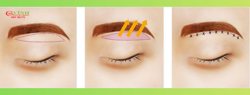 ki-thuat-lay-mo-bong-mat-tren-phong-kham-phau-thuat-tham-my