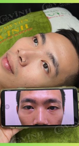 thay-doi-sau-khi-thuc-hien-cat-mi-mini-line