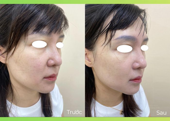 thay-doi-sau-khi-thuc-hien-hifu