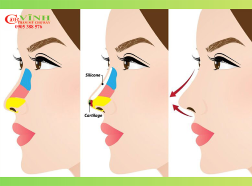 Nâng mũi đặt sống