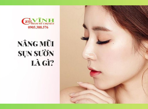 Nâng mũi sụn sườn