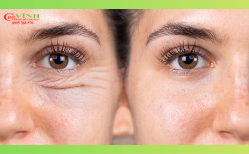Tiêm botox xóa nhăn