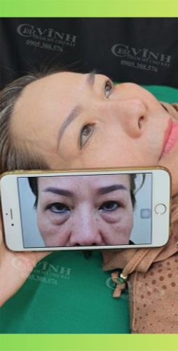 Cắt mí dưới có để lại sẹo không