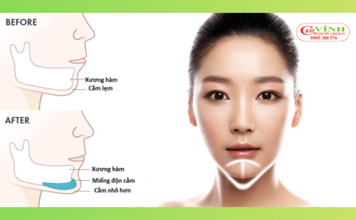 độn cằm giá bao nhiêu