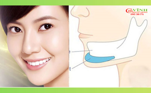 Độn cằm giữ được bao lâu