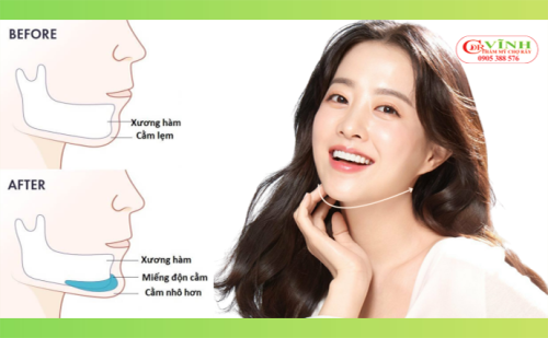 phẫu thuật độn cằm