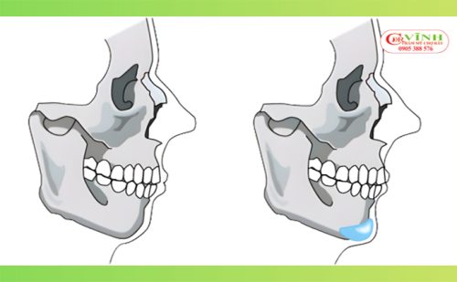 độn cằm ở đâu đẹp