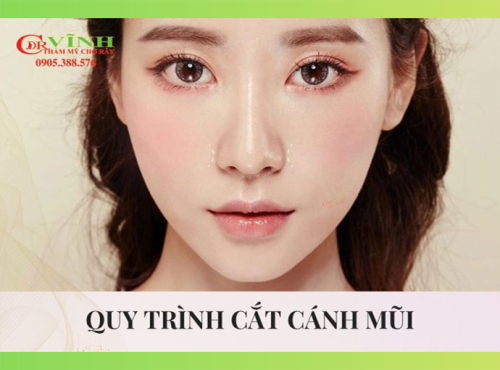 cắt cánh mũi